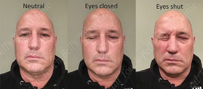 First signs of recovery after Bell's palsy - Onset