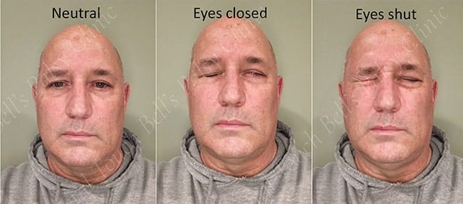 First signs of recovery after Bell's palsy - return of tonus