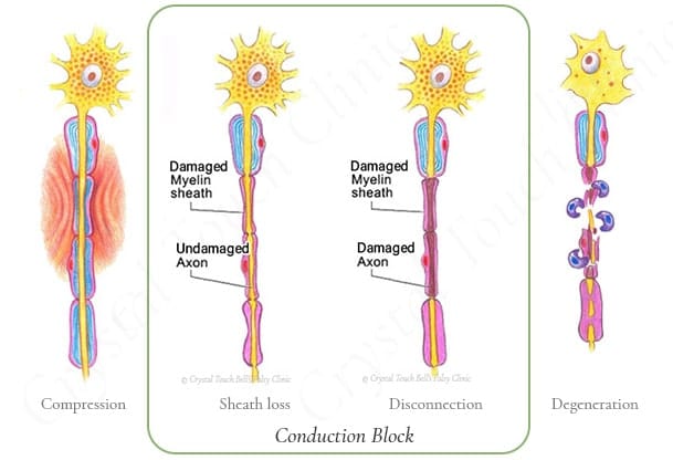 Stages of facial nerve damage during Bell's palsy