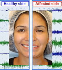 Healthy and affected side of Bell's palsy patient after 30 years of facial palsy