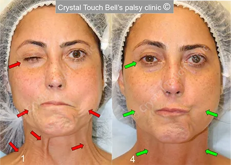 Patient C Balloon before and after