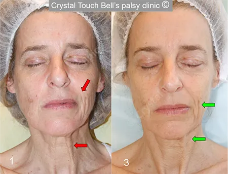 Patient D B Bells palsy Eyes closed before and after