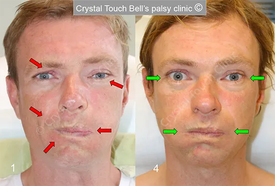 Patient EW Balloon before and after 550
