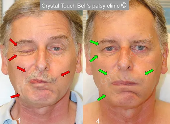 Patient MH Balloon before and after