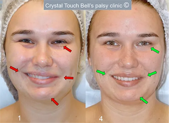 Patient ML Bell's palsy Smile before and after