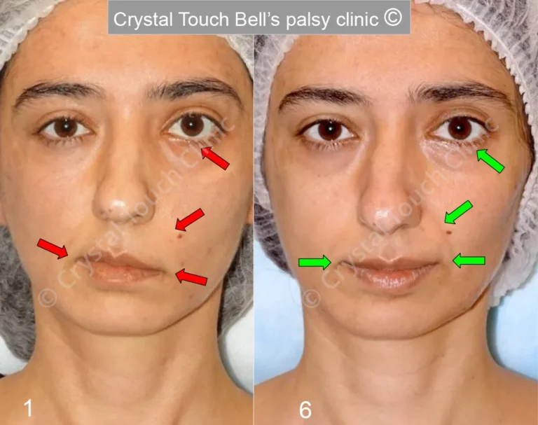 Patient MN Facial palsy after traumas tumours and post-operation - Smile before and after 500