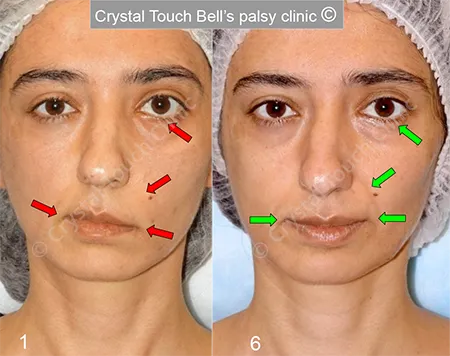 Patient MN Facial palsy after traumas tumours and post-operation - Smile before and after