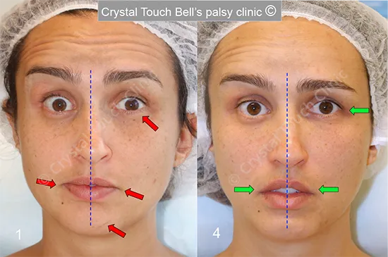 Patient MP Bell's palsy Surprise before and after