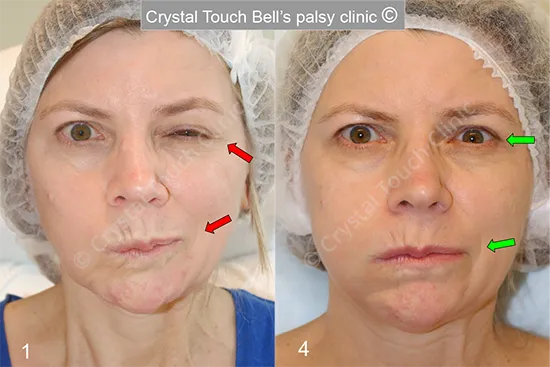 Patient NP Bell's palsy Balloon before and after