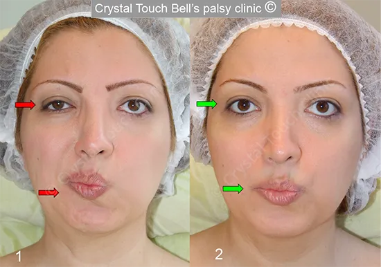 Rana Bells palsy Kiss before and after