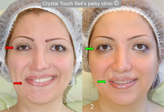 Rana Bell's palsy Smile before and after