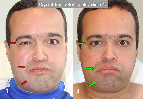 Patient WA Balloon before and after